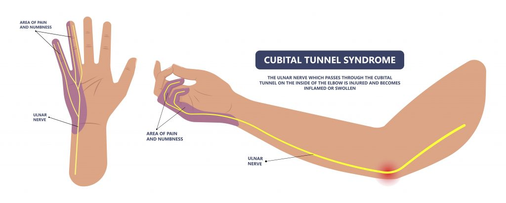 Elbow area showing cubital tunnel nerve pressure illustration